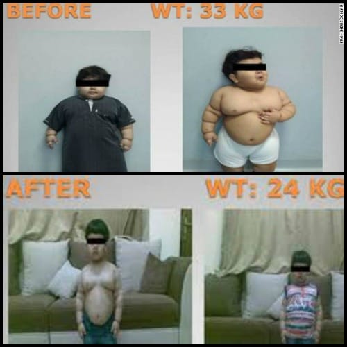Overweight 2-Year-Old Undergoes Weight-Loss Surgery 