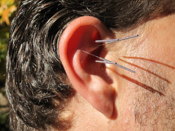 Does Ear Acupuncture Help Overweight Lose Weight? Photo Credit: www.universityherald.com 