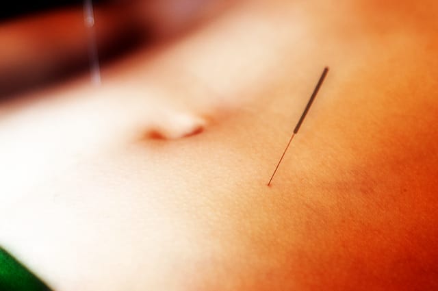 Some Hollywood Stars Include Acupuncture In Their Weight Loss Programs Original Image by Marnie Joyce in Flickr