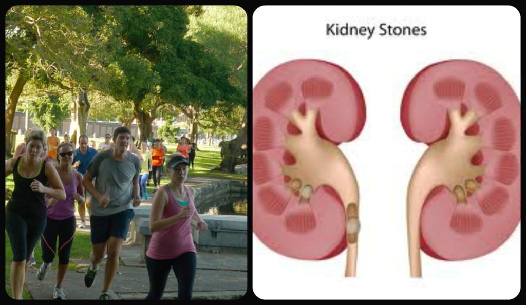 Exercise to Reduce Risk of Kidney Stones