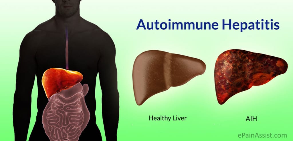 Autoimmune Hepatitis diet